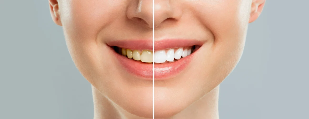 Teeth Whitening