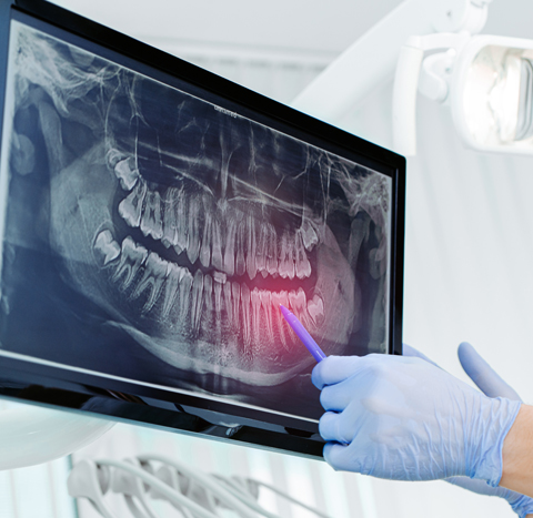 Digital X-Rays in Keller