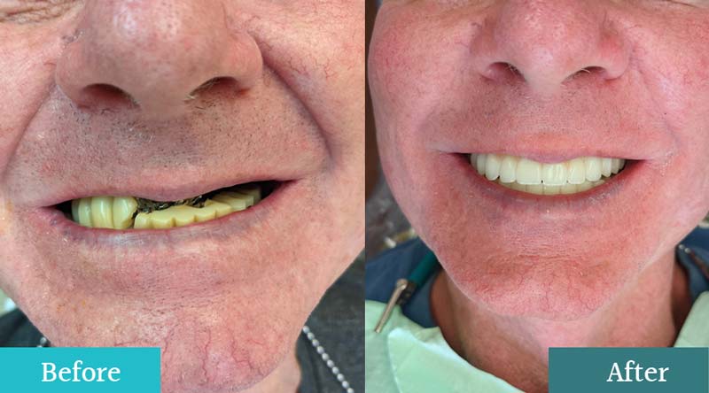 Why Choose Implant-Supported Dentures