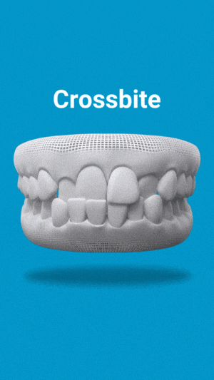 Crossbite treatment near me