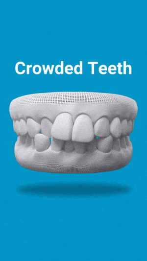 Crowded teeth treatment in Keller