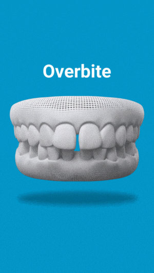 Overbite Treatment in Keller, TX