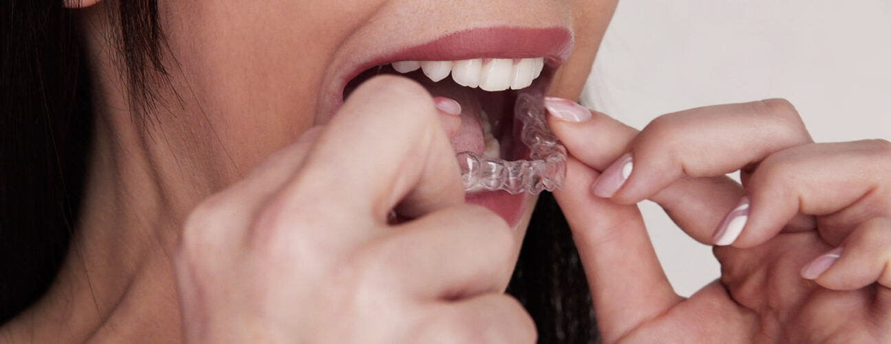 Invisalign(1)