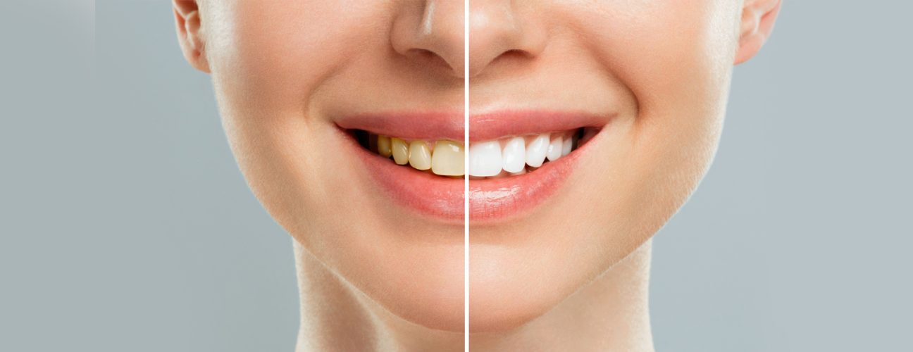 How to Get Rid of Yellow Stains on Teeth: Whitening Options That Last