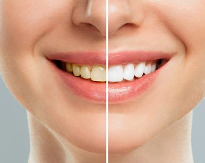 How to Get Rid of Yellow Stains on Teeth: Whitening Options That Last