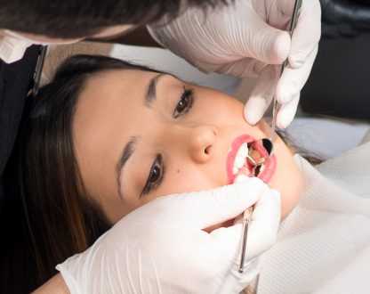 Do Dental Sealants Really Prevent Cavities?