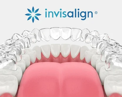 How Invisalign Aligners in Keller Work to Straighten Teeth